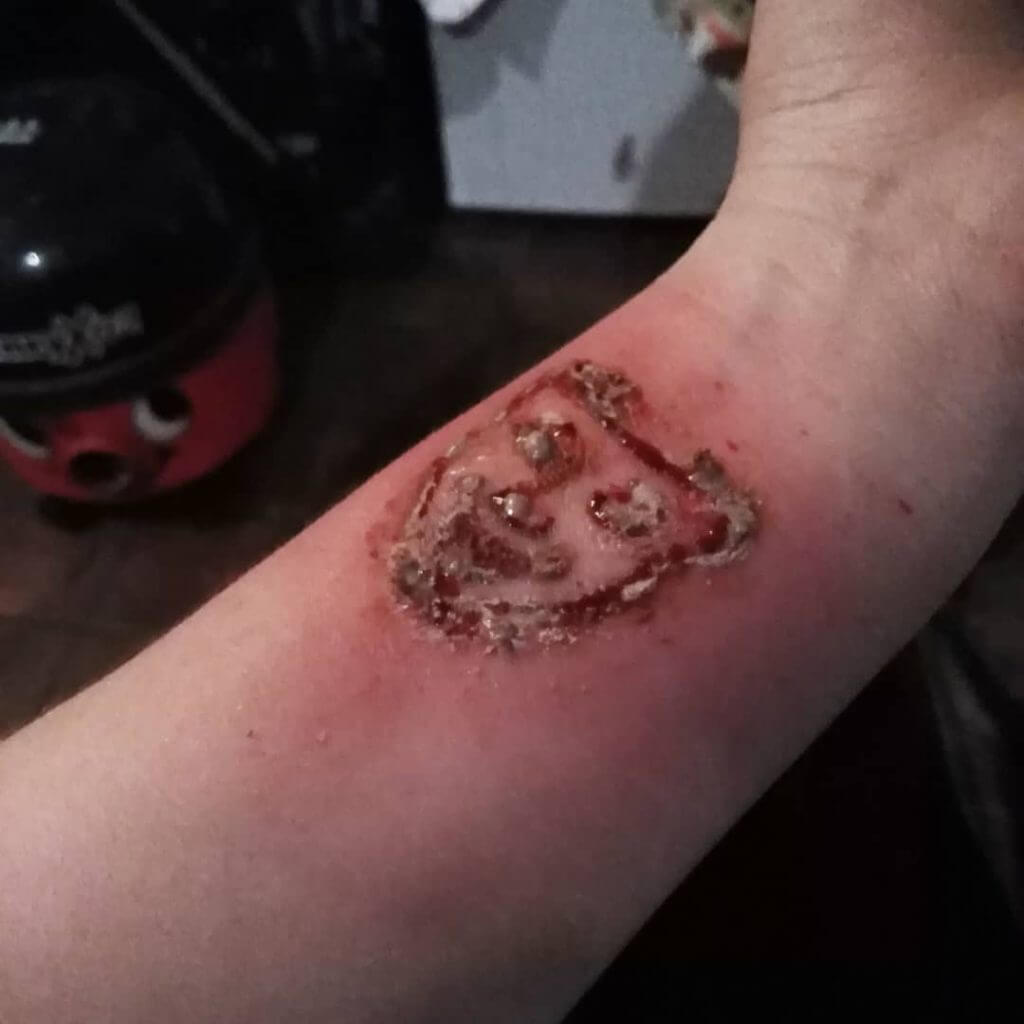 Tattoo risks - infected tattoo on the hand