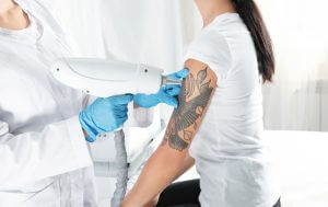 Laser removal of a tattoo from the left hand