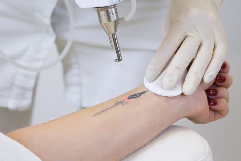 Removal of a tattoo using laser