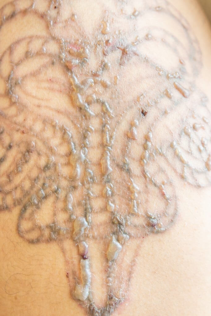 Skin after laser tattoo removal